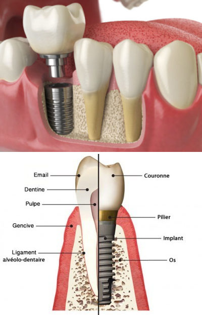 implant dentaire paris 9